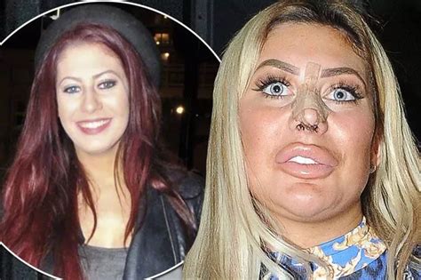 chloe ferry liposuction|chloe ferry before and after photos.